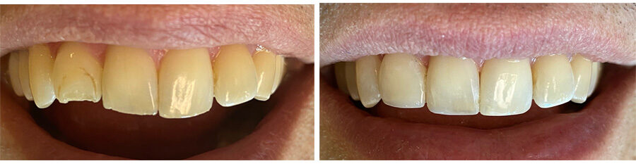 Before and After Tooth Bonding performed by Stacia Krantz, DDS