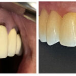 Thumbnail of http://Implants%20and%20Crowns%20performed%20by%20Stacia%20Krantz,%20DDS